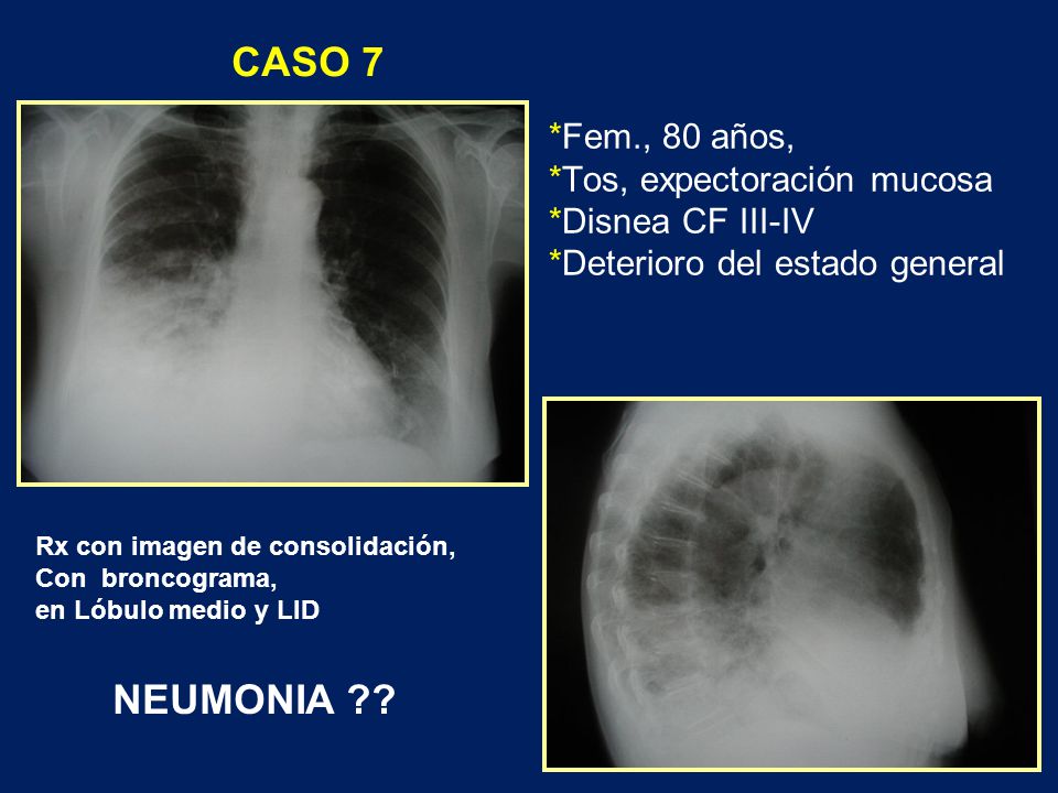 CASO 7 *Fem., 80 años, *Tos, expectoración mucosa *Disnea CF III-IV *Deterioro del estado general.