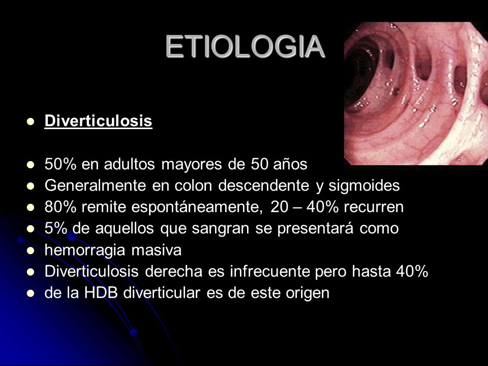 ETIOLOGIA Diverticulosis 50% en adultos mayores de 50 años