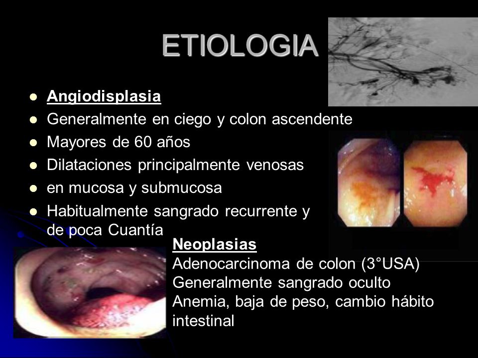 ETIOLOGIA Angiodisplasia Generalmente en ciego y colon ascendente