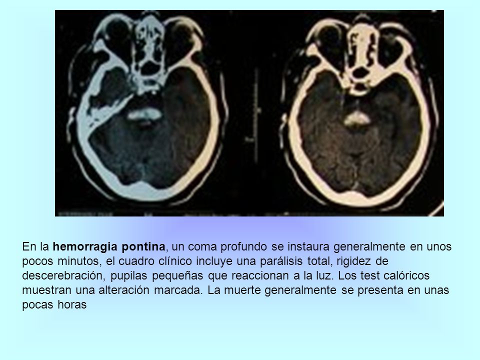 En la hemorragia pontina, un coma profundo se instaura generalmente en unos pocos minutos, el cuadro clínico incluye una parálisis total, rigidez de descerebración, pupilas pequeñas que reaccionan a la luz.