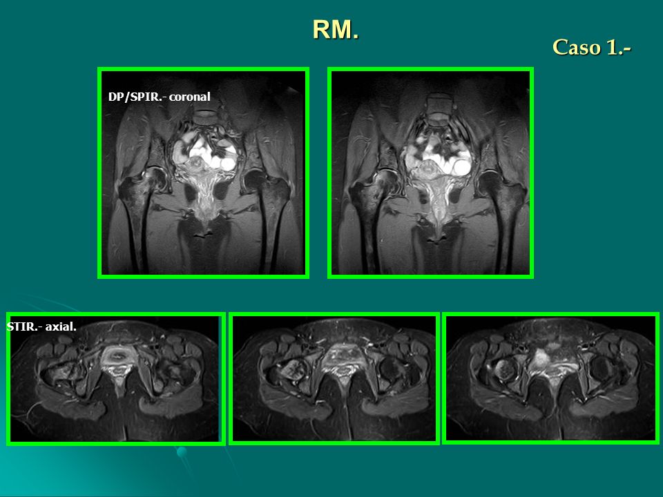 RM. Caso 1.- DP/SPIR.- coronal STIR.- axial.