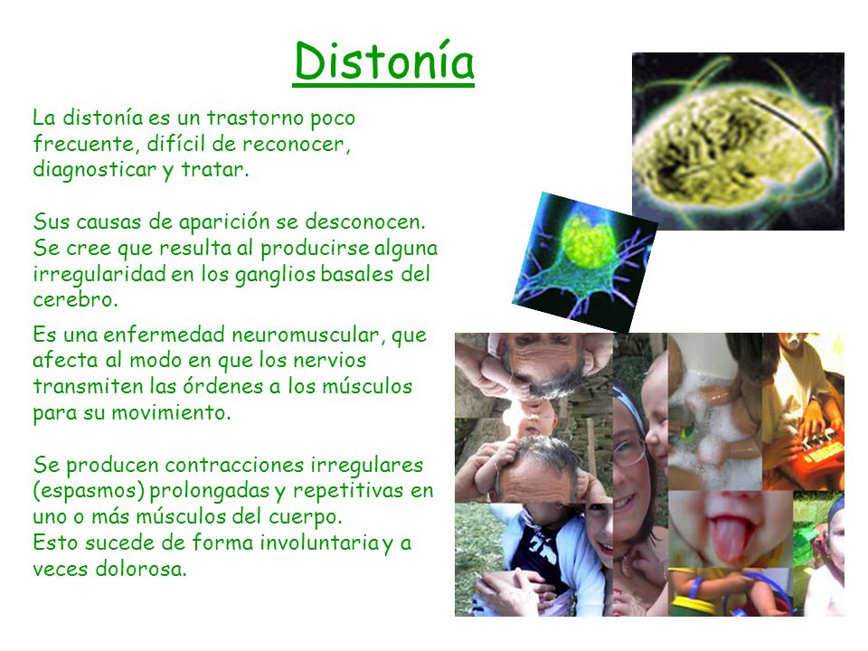 Distonía La distonía es un trastorno poco frecuente, difícil de reconocer, diagnosticar y tratar.