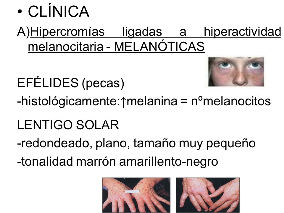 CLÍNICA Hipercromías ligadas a hiperactividad melanocitaria - MELANÓTICAS. EFÉLIDES (pecas) -histológicamente:↑melanina = nºmelanocitos.