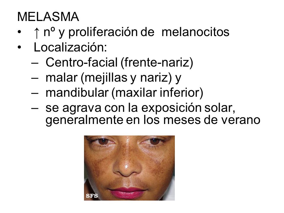 MELASMA ↑ nº y proliferación de melanocitos. Localización: Centro-facial (frente-nariz) malar (mejillas y nariz) y.