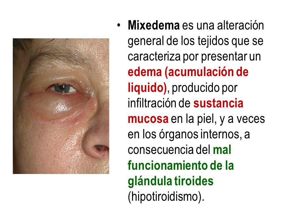 Mixedema es una alteración general de los tejidos que se caracteriza por presentar un edema (acumulación de liquido), producido por infiltración de sustancia mucosa en la piel, y a veces en los órganos internos, a consecuencia del mal funcionamiento de la glándula tiroides (hipotiroidismo).