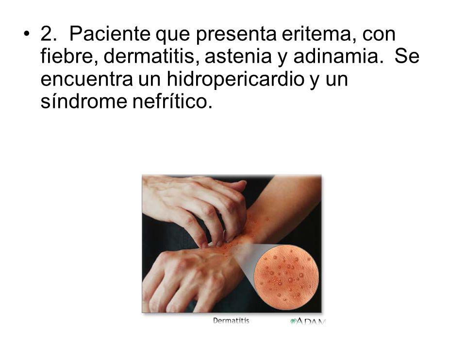 2. Paciente que presenta eritema, con fiebre, dermatitis, astenia y adinamia. Se encuentra un hidropericardio y un síndrome nefrítico.