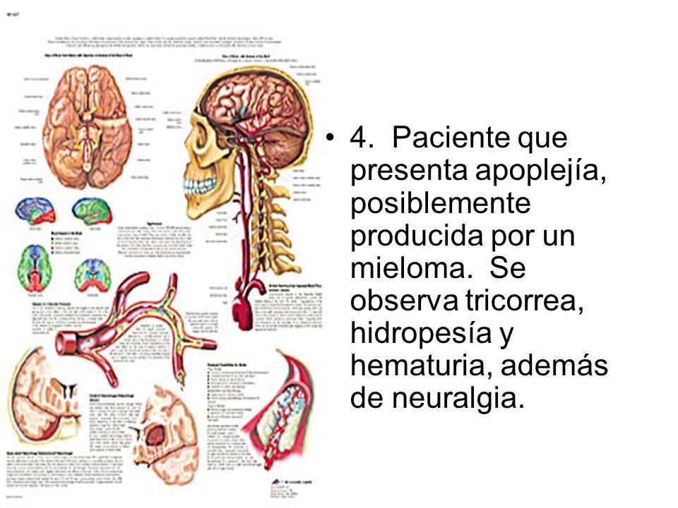 4. Paciente que presenta apoplejía, posiblemente producida por un mieloma. Se observa tricorrea, hidropesía y hematuria, además de neuralgia.
