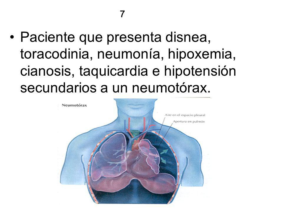 7 Paciente que presenta disnea, toracodinia, neumonía, hipoxemia, cianosis, taquicardia e hipotensión secundarios a un neumotórax.
