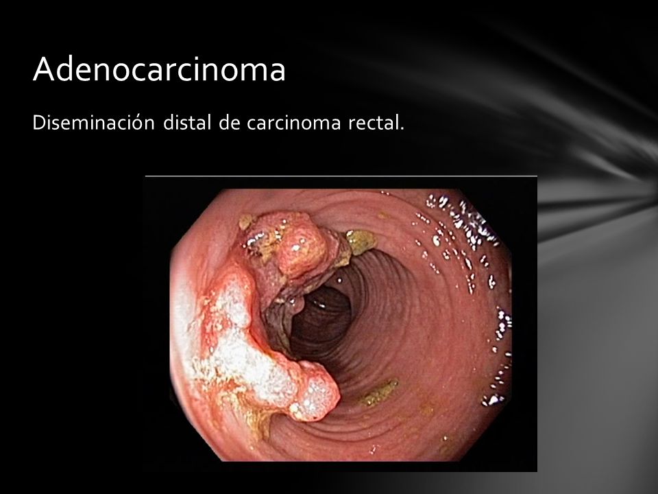 Adenocarcinoma Diseminación distal de carcinoma rectal.