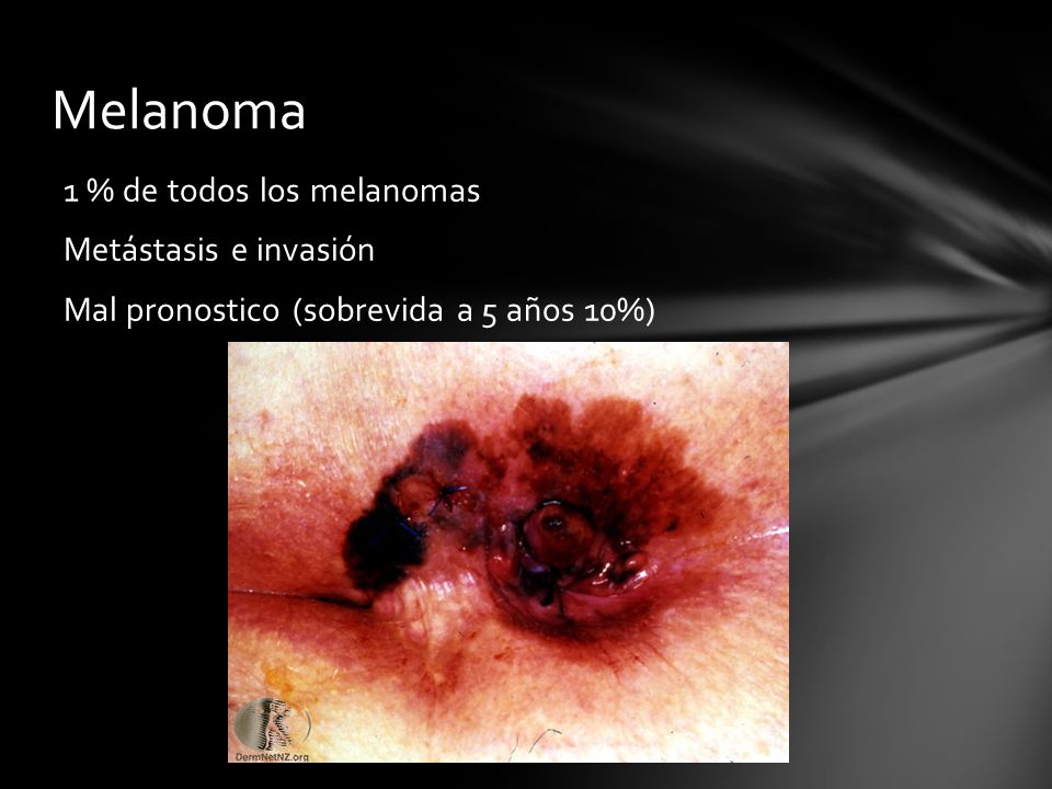 Melanoma 1 % de todos los melanomas Metástasis e invasión Mal pronostico (sobrevida a 5 años 10%)
