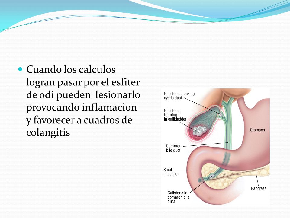 Cuando los calculos logran pasar por el esfiter de odi pueden lesionarlo provocando inflamacion y favorecer a cuadros de colangitis
