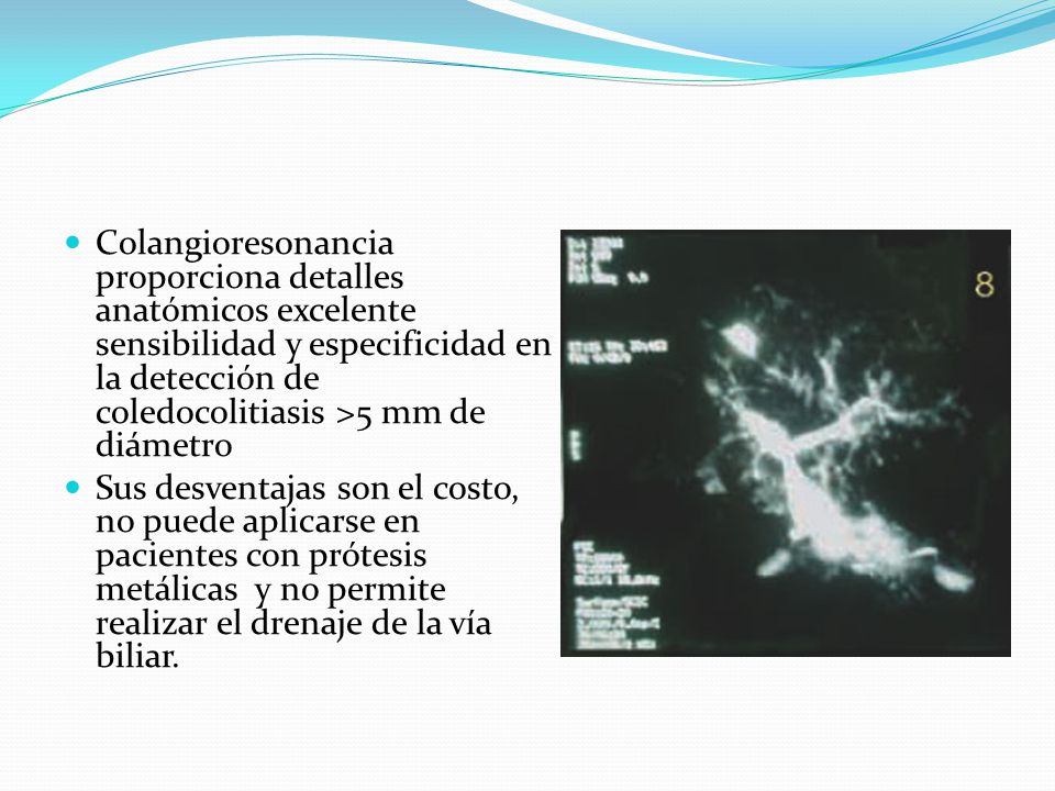 Colangioresonancia proporciona detalles anatómicos excelente sensibilidad y especificidad en la detección de coledocolitiasis >5 mm de diámetro