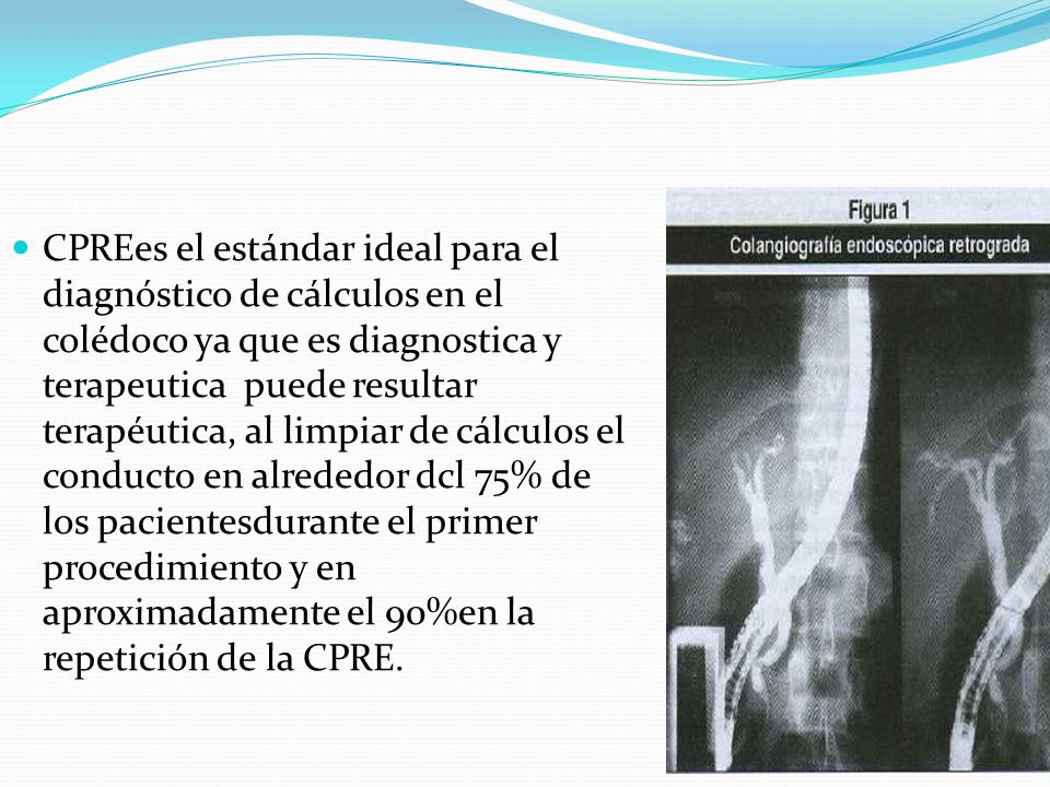 CPREes el estándar ideal para el diagnóstico de cálculos en el colédoco ya que es diagnostica y terapeutica puede resultar terapéutica, al limpiar de cálculos el conducto en alrededor dcl 75% de los pacientesdurante el primer procedimiento y en aproximadamente el 90%en la repetición de la CPRE.
