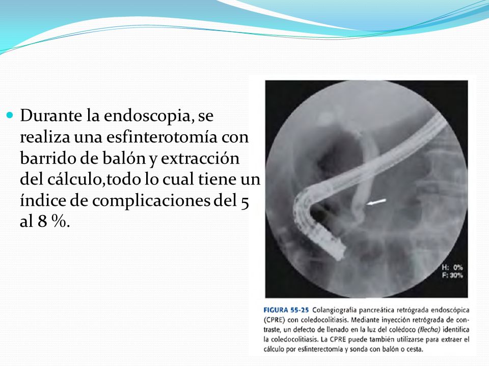 Durante la endoscopia, se realiza una esfinterotomía con barrido de balón y extracción del cálculo,todo lo cual tiene un índice de complicaciones del 5 al 8 %.