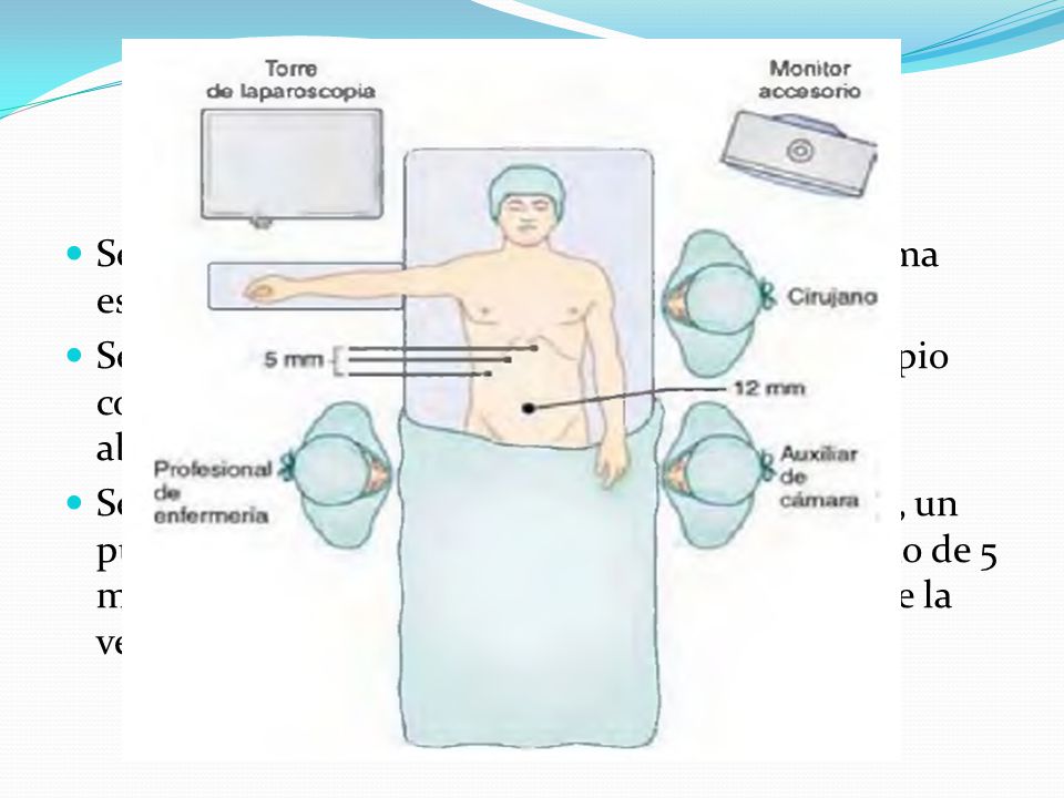Se inserta en la cavidad peritoneal una cánula roma especial (cánula de Hasson) y se fija a la fascia