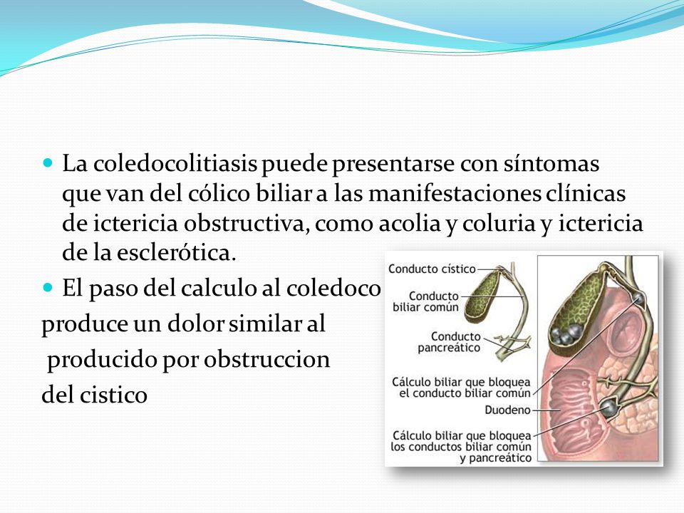 La coledocolitiasis puede presentarse con síntomas que van del cólico biliar a las manifestaciones clínicas de ictericia obstructiva, como acolia y coluria y ictericia de la esclerótica.