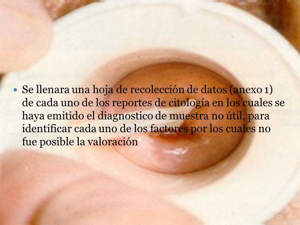 Se llenara una hoja de recolección de datos (anexo 1) de cada uno de los reportes de citología en los cuales se haya emitido el diagnostico de muestra no útil, para identificar cada uno de los factores por los cuales no fue posible la valoración