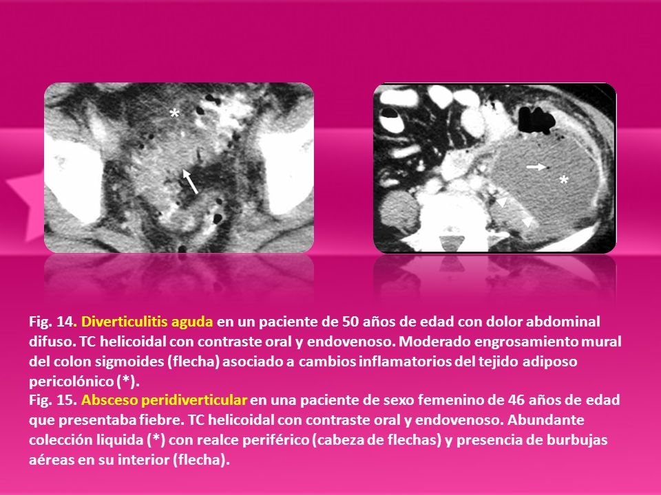 Fig. 14. Diverticulitis aguda en un paciente de 50 años de edad con dolor abdominal difuso. TC helicoidal con contraste oral y endovenoso. Moderado engrosamiento mural del colon sigmoides (flecha) asociado a cambios inflamatorios del tejido adiposo pericolónico (*).