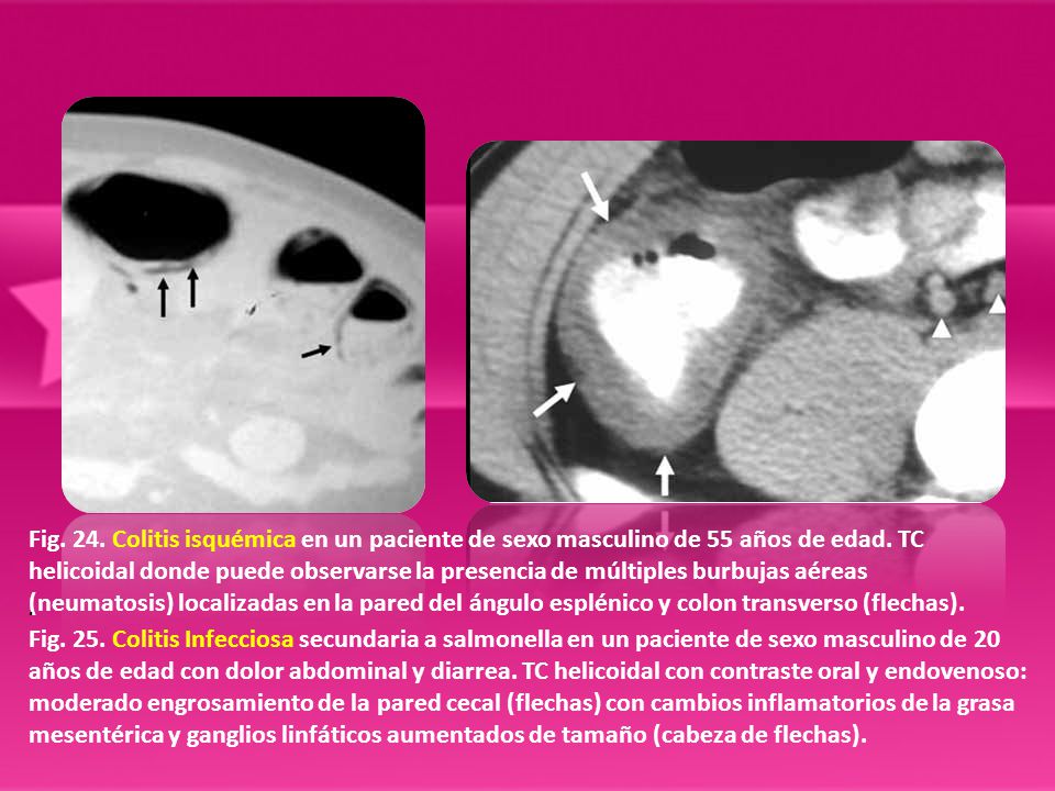 Fig. 24. Colitis isquémica en un paciente de sexo masculino de 55 años de edad. TC helicoidal donde puede observarse la presencia de múltiples burbujas aéreas (neumatosis) localizadas en la pared del ángulo esplénico y colon transverso (flechas).