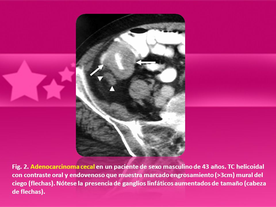 Fig. 2. Adenocarcinoma cecal en un paciente de sexo masculino de 43 años.