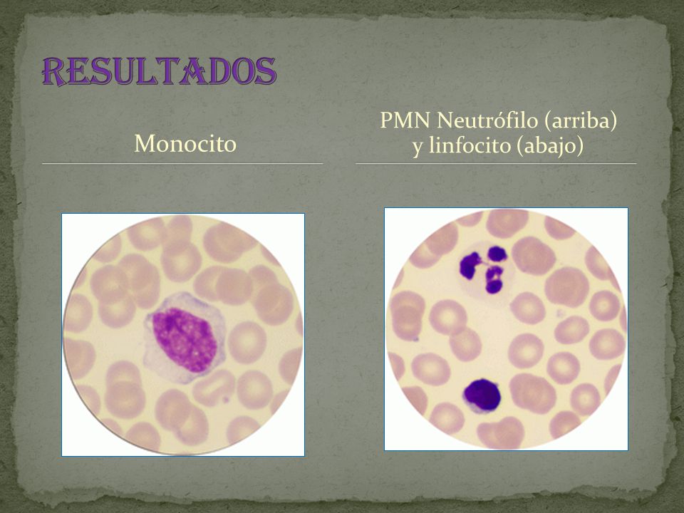 PMN Neutrófilo (arriba) y linfocito (abajo)