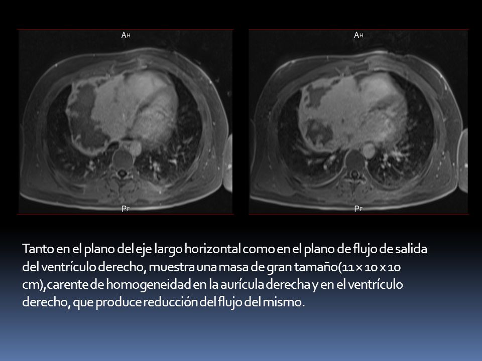 Tanto en el plano del eje largo horizontal como en el plano de flujo de salida del ventrículo derecho, muestra una masa de gran tamaño(11 × 10 x 10 cm),carente de homogeneidad en la aurícula derecha y en el ventrículo derecho, que produce reducción del flujo del mismo.