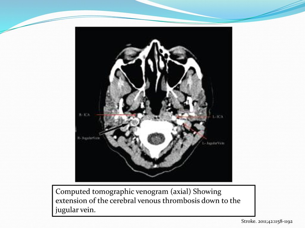 Computed tomographic venogram (axial) Showing extension of the cerebral venous thrombosis down to the jugular vein.