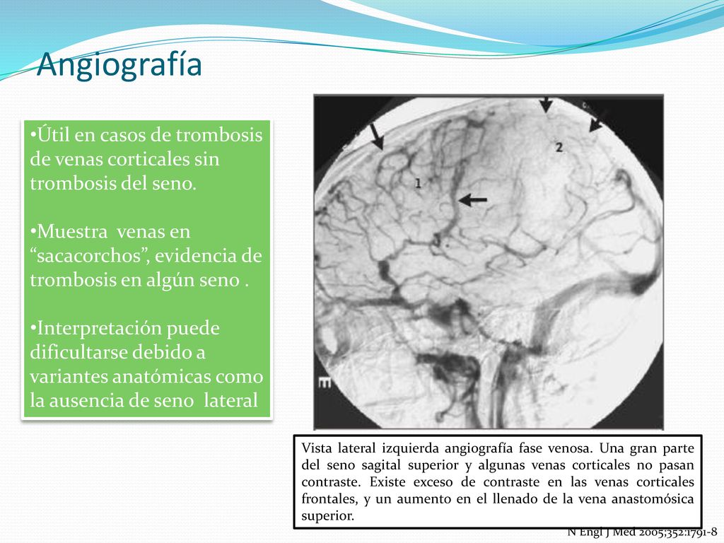 Angiografía Útil en casos de trombosis de venas corticales sin trombosis del seno.