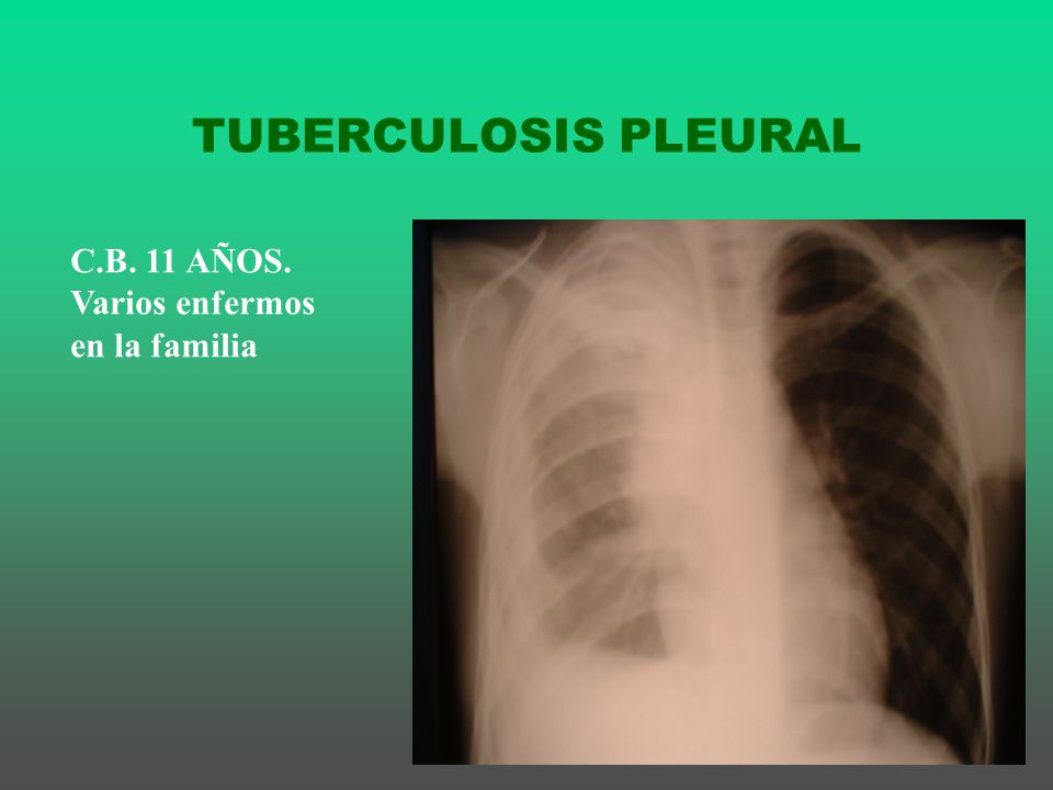 TUBERCULOSIS PLEURAL C.B. 11 AÑOS. Varios enfermos en la familia