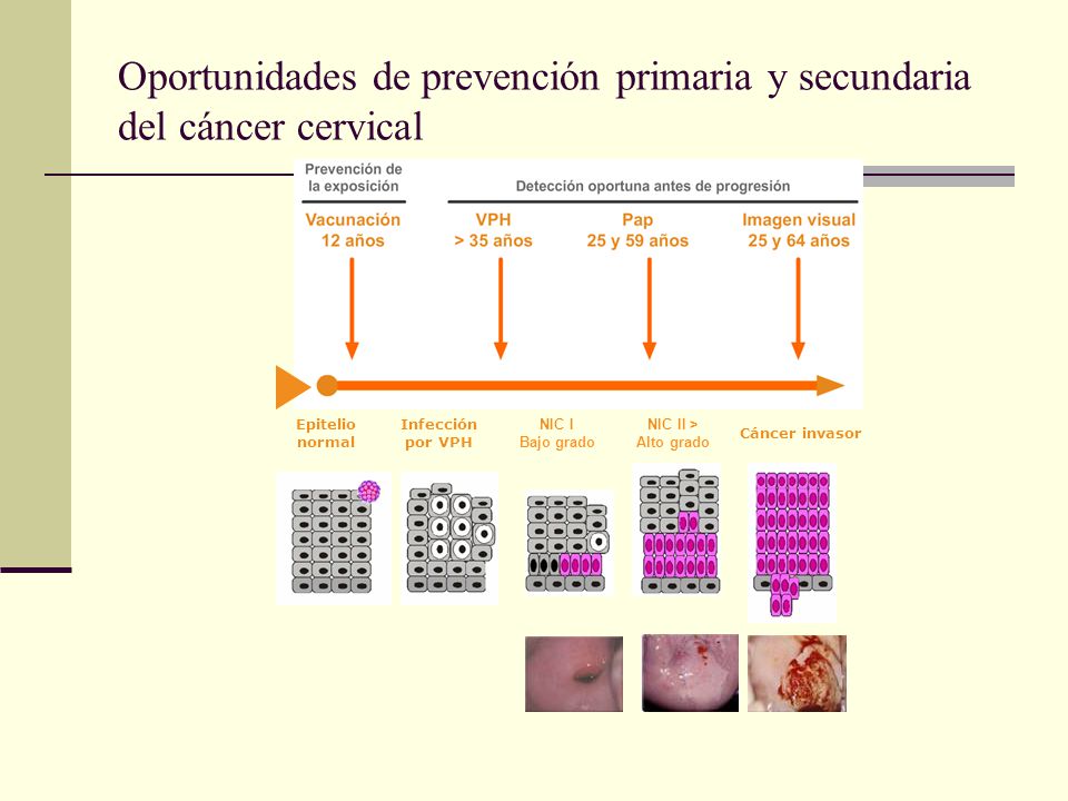 Oportunidades de prevención primaria y secundaria del cáncer cervical