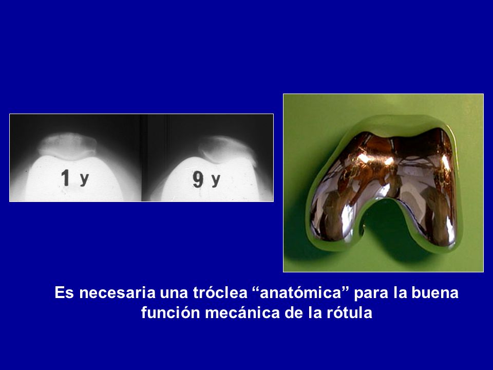 Es necesaria una tróclea anatómica para la buena función mecánica de la rótula