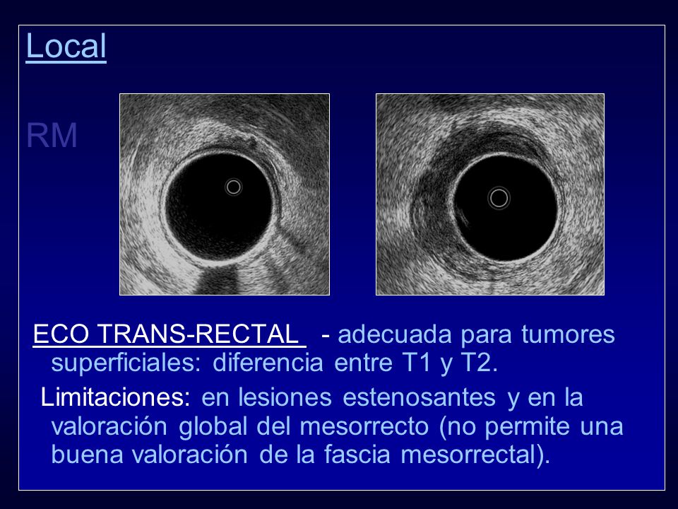 Local RM. ECO TRANS-RECTAL - adecuada para tumores superficiales: diferencia entre T1 y T2.
