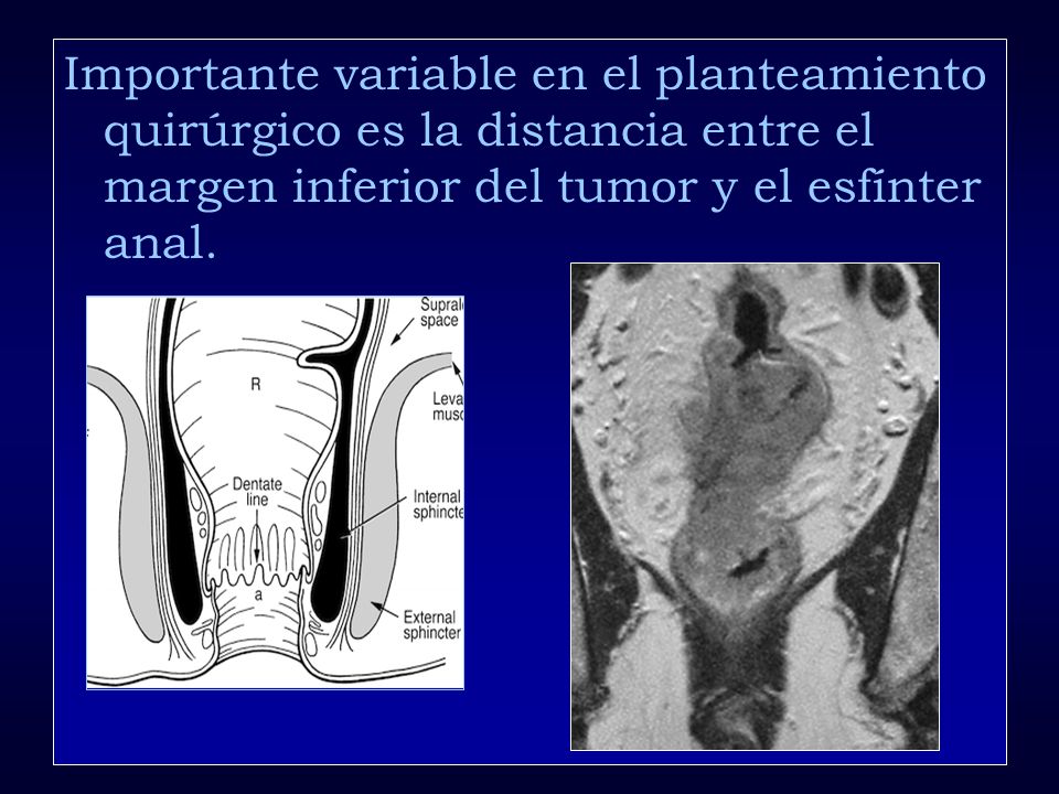 Importante variable en el planteamiento quirúrgico es la distancia entre el margen inferior del tumor y el esfínter anal.