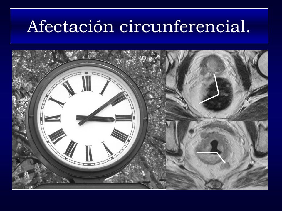 Afectación circunferencial.