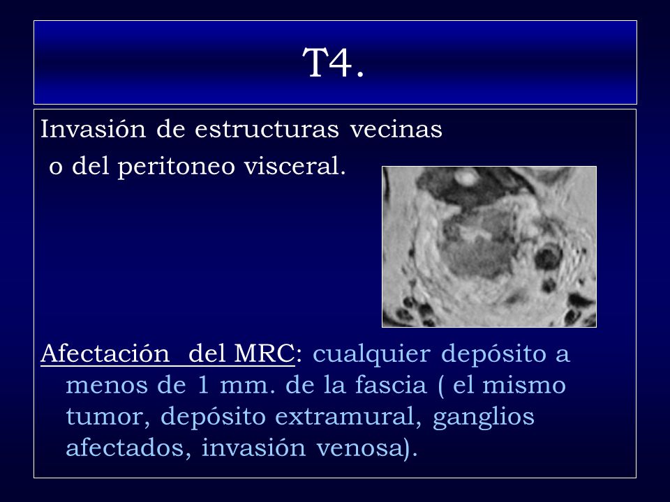 T4. Invasión de estructuras vecinas o del peritoneo visceral.
