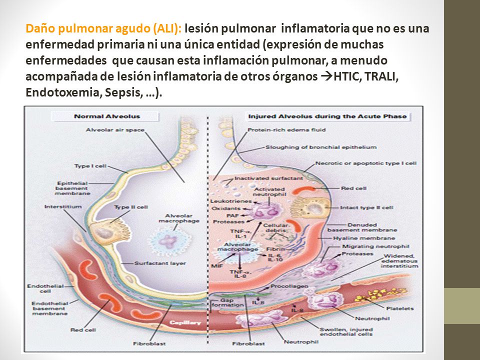 Daño pulmonar agudo (ALI): lesión pulmonar inflamatoria que no es una enfermedad primaria ni una única entidad (expresión de muchas enfermedades que causan esta inflamación pulmonar, a menudo acompañada de lesión inflamatoria de otros órganos HTIC, TRALI, Endotoxemia, Sepsis, …).
