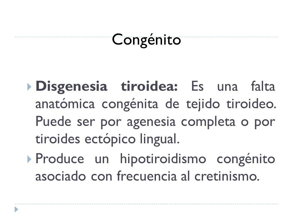 agenesia por tiroides