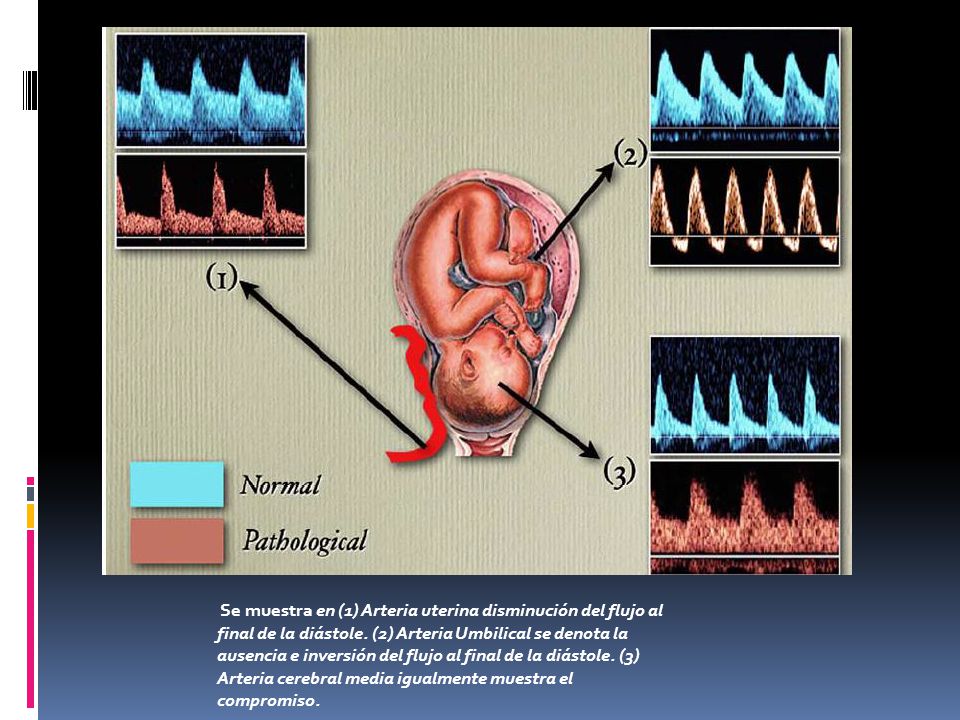 Se muestra en (1) Arteria uterina disminución del flujo al final de la diástole.