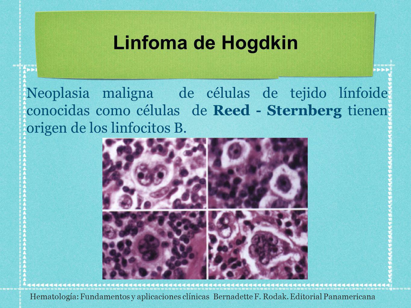 Linfoma de Hogdkin Neoplasia maligna de células de tejido línfoide conocidas como células de Reed - Sternberg tienen origen de los linfocitos B.