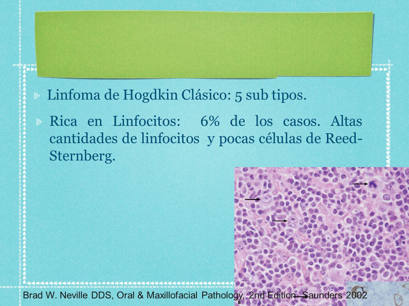 Linfoma de Hogdkin Clásico: 5 sub tipos.