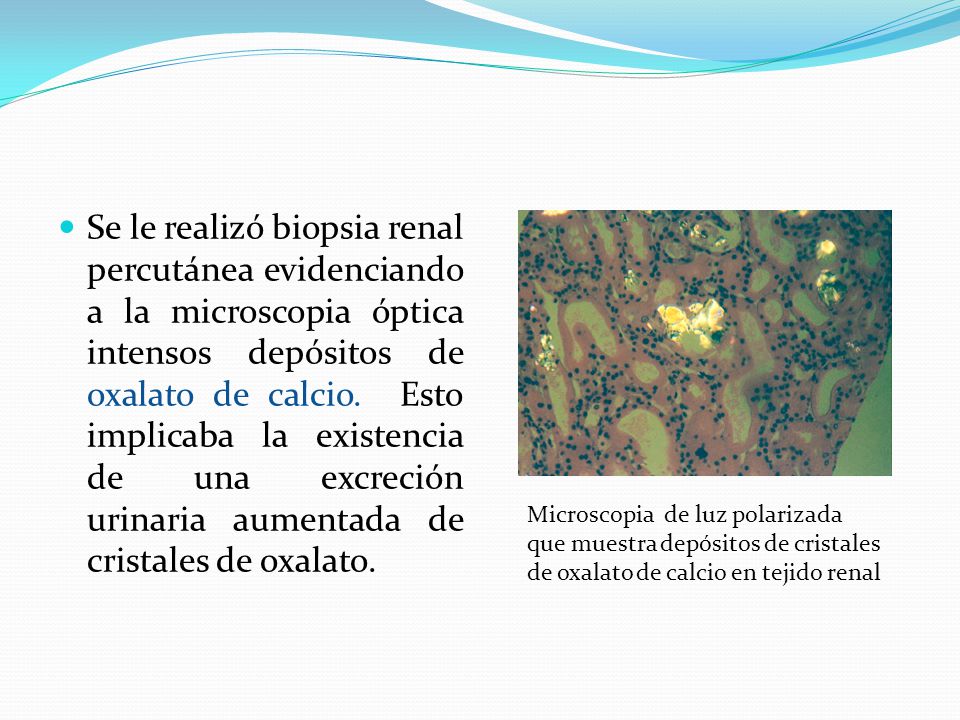 Se le realizó biopsia renal percutánea evidenciando a la microscopia óptica intensos depósitos de oxalato de calcio. Esto implicaba la existencia de una excreción urinaria aumentada de cristales de oxalato.