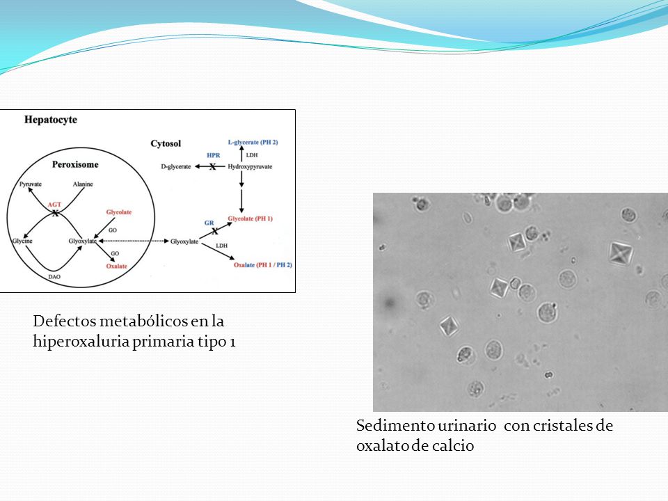 Defectos metabólicos en la hiperoxaluria primaria tipo 1