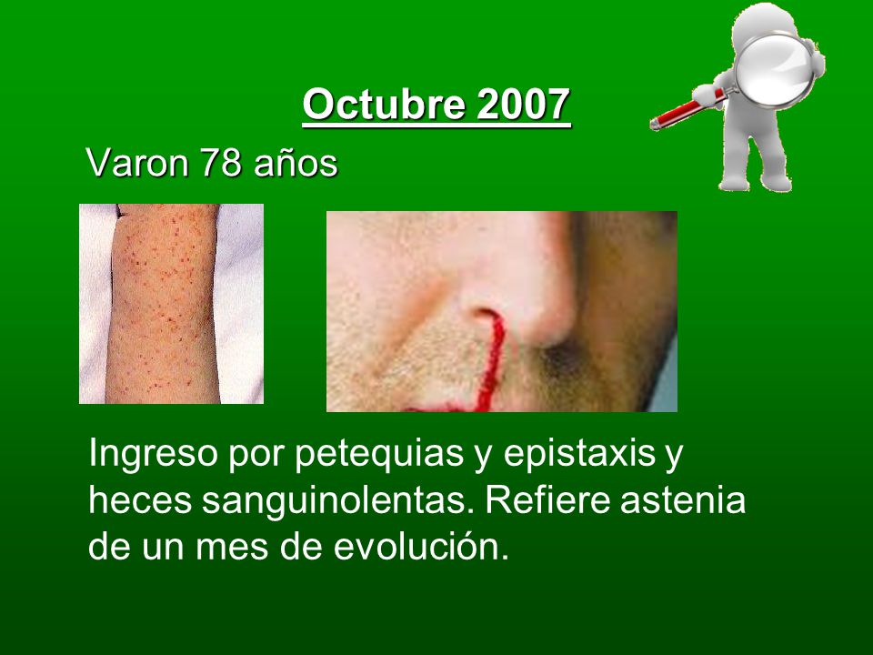 Octubre 2007 Varon 78 años. Ingreso por petequias y epistaxis y heces sanguinolentas.