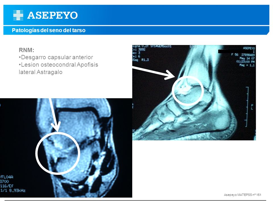 Desgarro capsular anterior