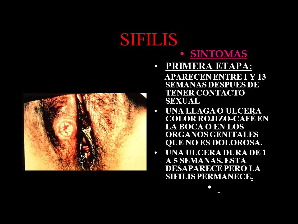 SIFILIS SINTOMAS PRIMERA ETAPA: