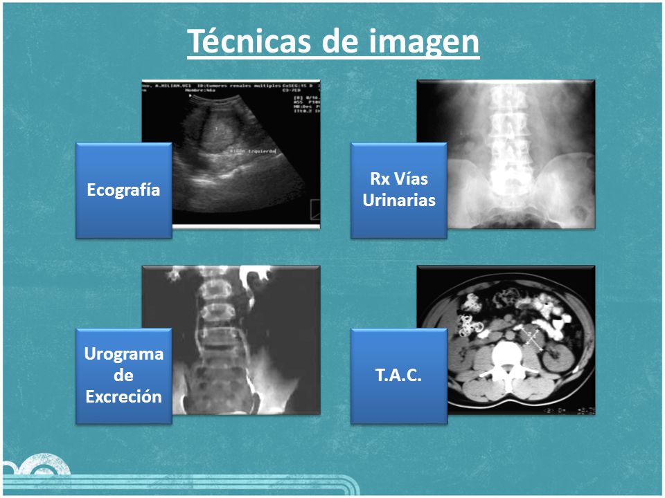 Técnicas de imagen Rx Vías Urinarias Ecografía Urograma de Excreción