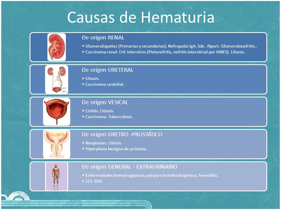 Causas de Hematuria De origen RENAL De origen URETERAL