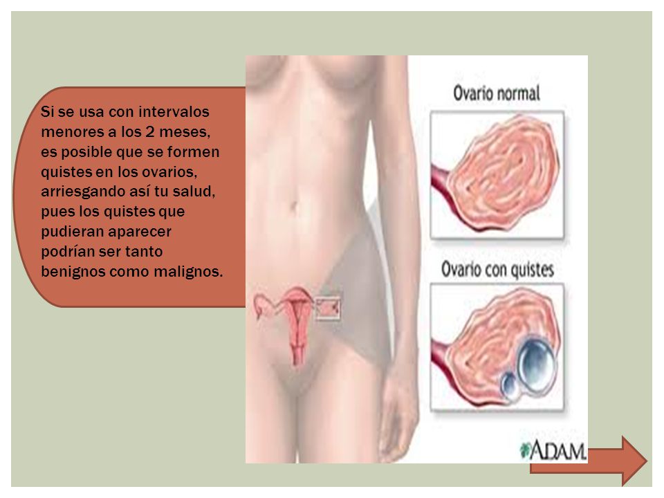 Si se usa con intervalos menores a los 2 meses, es posible que se formen quistes en los ovarios, arriesgando así tu salud, pues los quistes que pudieran aparecer podrían ser tanto benignos como malignos.