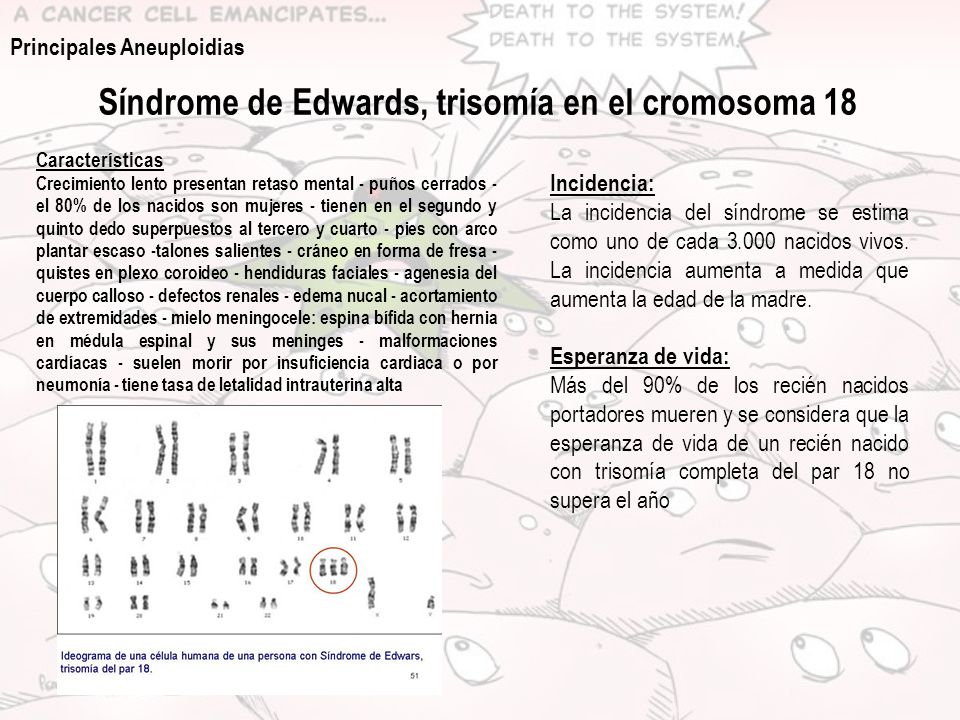 Síndrome de Edwards, trisomía en el cromosoma 18