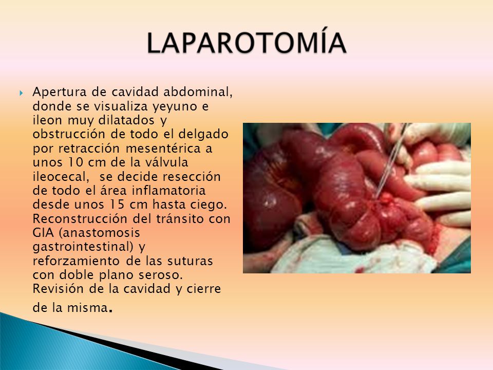 Apertura de cavidad abdominal, donde se visualiza yeyuno e ileon muy dilatados y obstrucción de todo el delgado por retracción mesentérica a unos 10 cm de la válvula ileocecal, se decide resección de todo el área inflamatoria desde unos 15 cm hasta ciego.